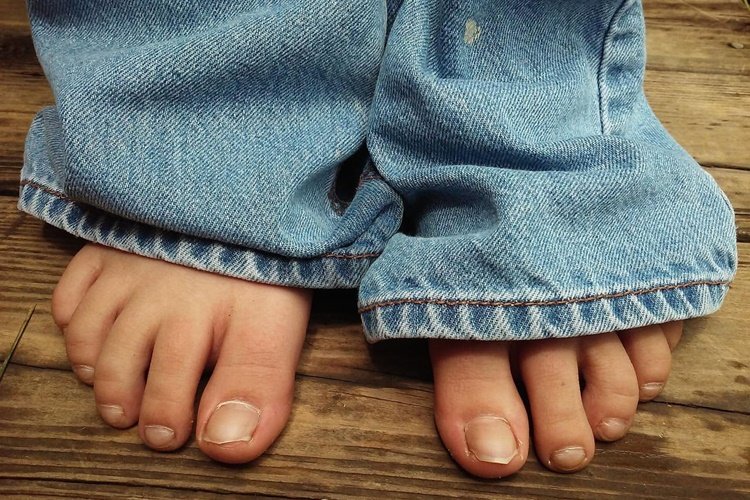 Qué es la onicocriptosis y por qué aparece