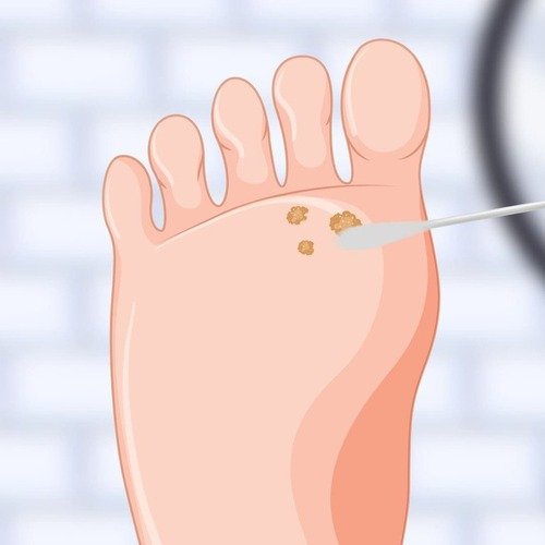 Cómo usar ácido nítrico para verrugas y lesiones cutáneas 1