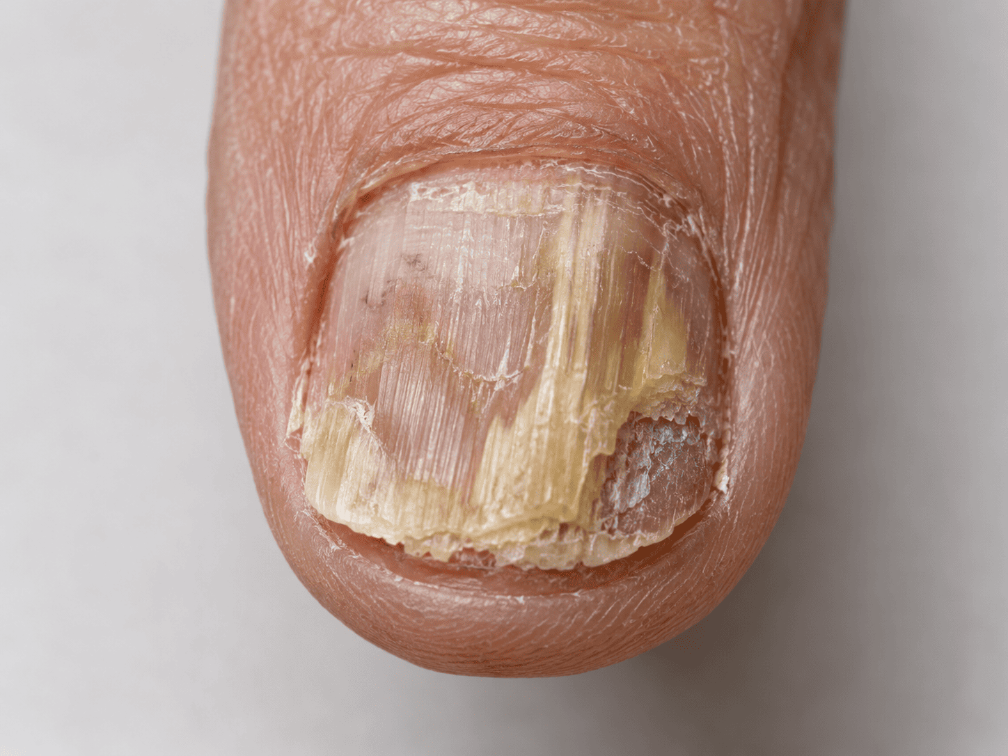 Onicodistrofia por qué se deforman las uñas de los pies y cómo recuperar su salud